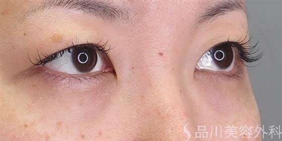 症例NO.48299のBEFORE写真