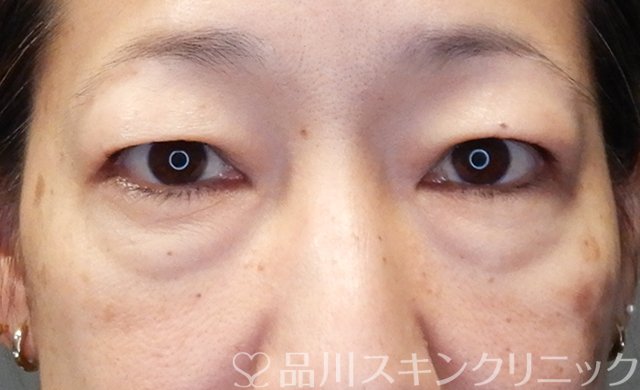 症例NO.68166のBEFORE写真