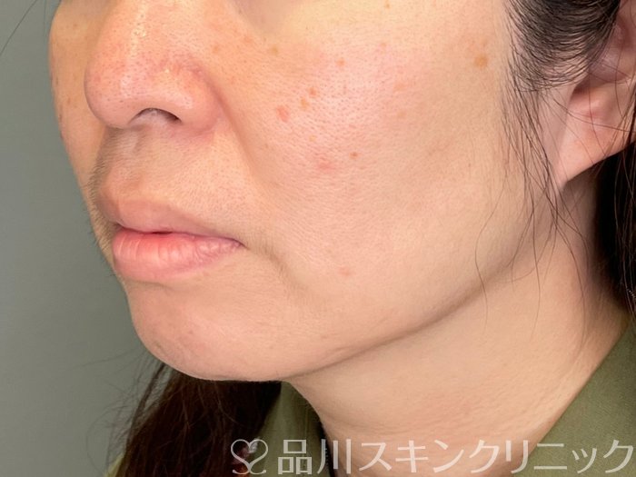 症例NO.69460のBEFORE写真