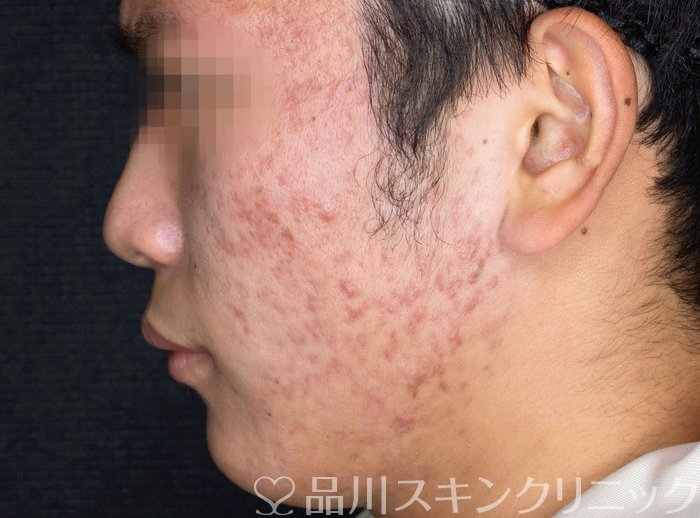 症例NO.63845のBEFORE写真