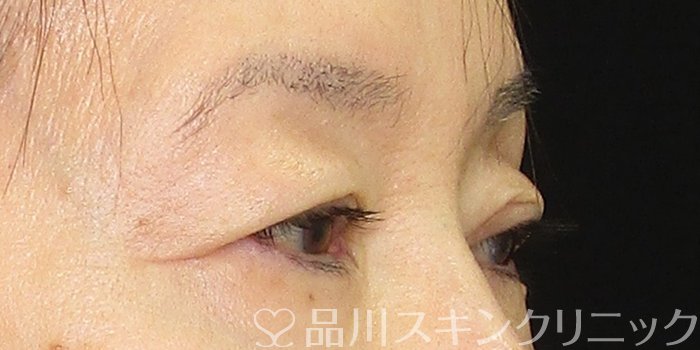 症例NO.69791のBEFORE写真