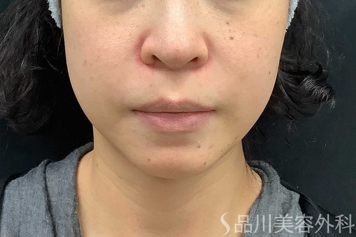 症例NO.69519のBEFORE写真