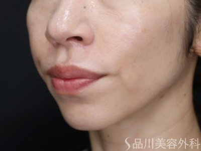 症例NO.72200のAFTER写真