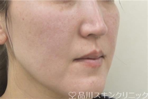 症例NO.31244のBEFORE写真