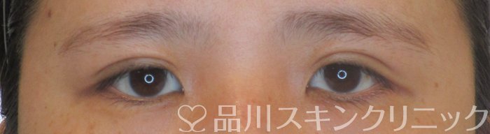 症例NO.64312のAFTER写真