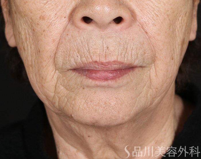 症例NO.73661のBEFORE写真