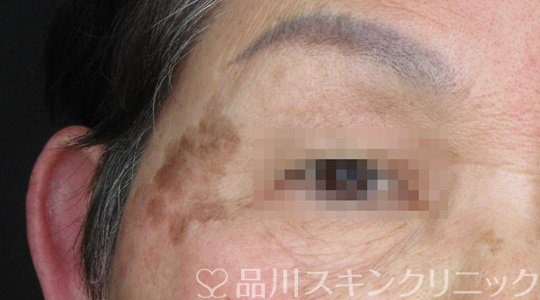 症例NO.69312のBEFORE写真