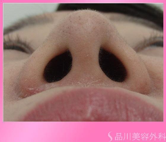 症例NO.13894のAFTER写真