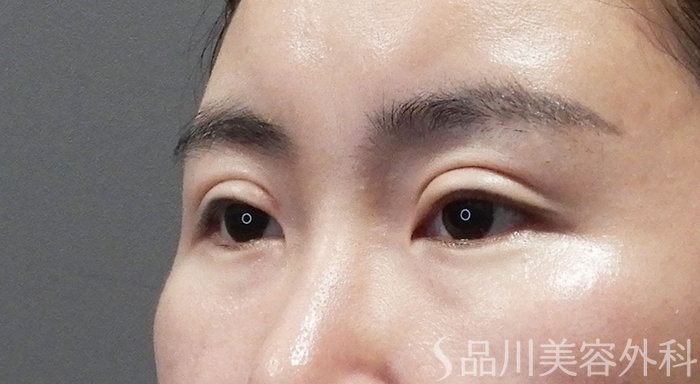 症例NO.69335のAFTER写真