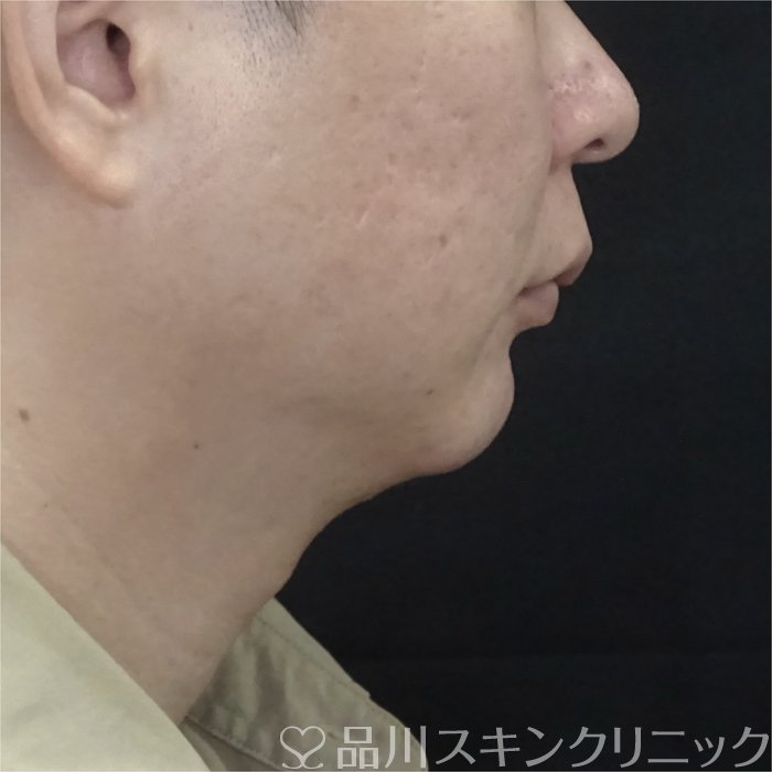 症例NO.72629のAFTER写真