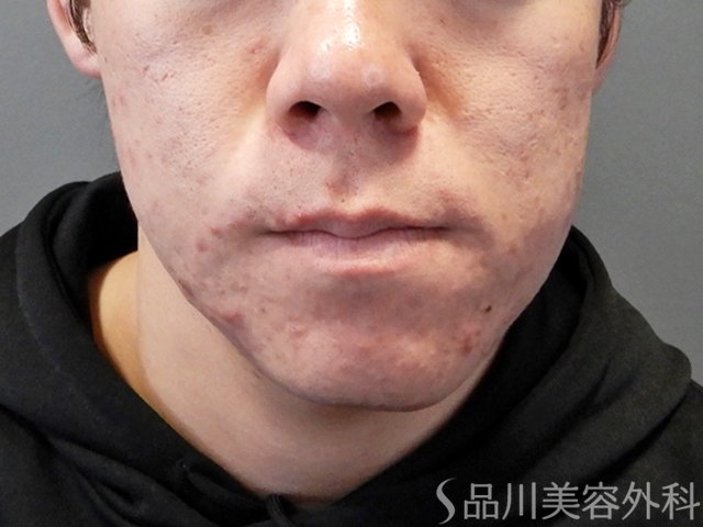 症例NO.69395のBEFORE写真