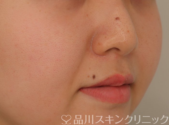 症例NO.70741のAFTER写真