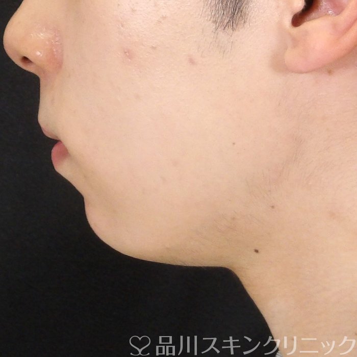 症例NO.70546のAFTER写真
