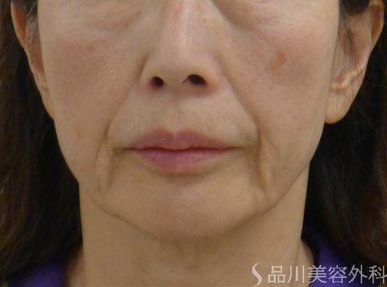 症例NO.49947のBEFORE写真