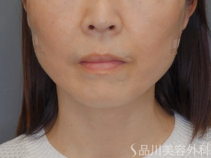 症例NO.72558のAFTER写真