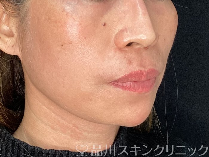 症例NO.72661のAFTER写真