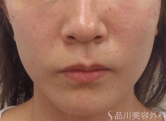 症例NO.3836のAFTER写真