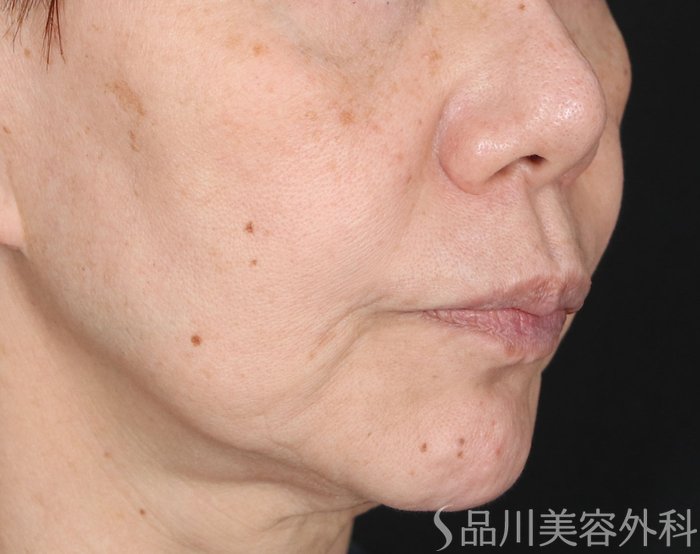 症例NO.71664のBEFORE写真