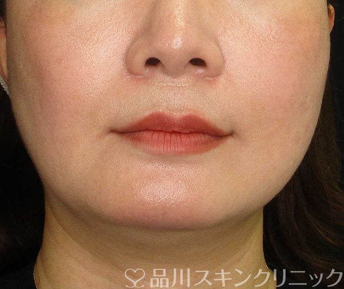 症例NO.67941のBEFORE写真