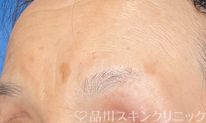症例NO.74752のBEFORE写真