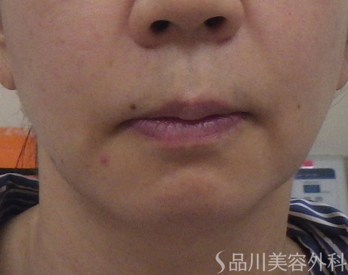 症例NO.71833のBEFORE写真