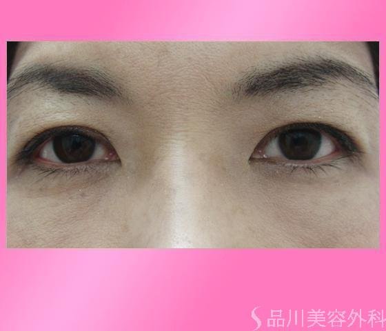 症例NO.2980のAFTER写真