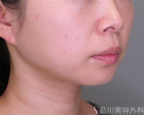 症例NO.47962のBEFORE写真