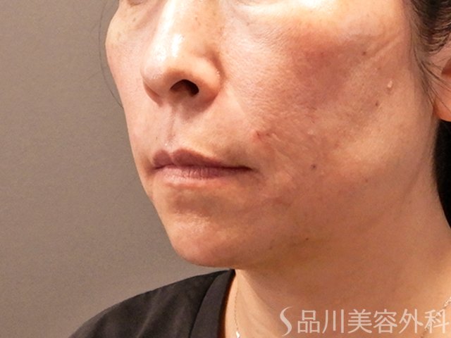症例NO.70858のAFTER写真