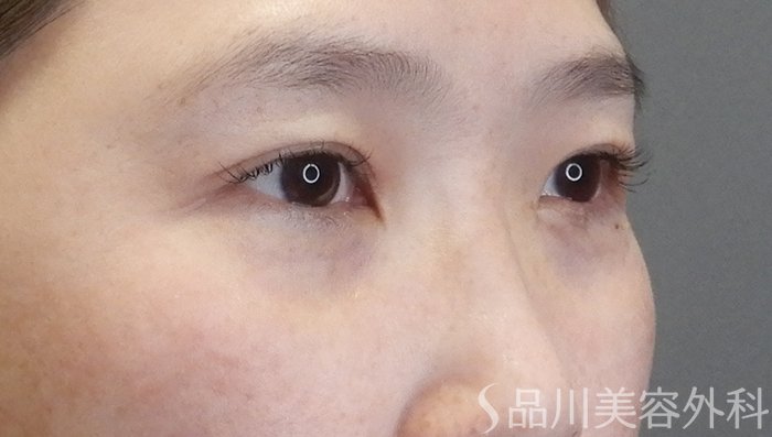 症例NO.65368のAFTER写真