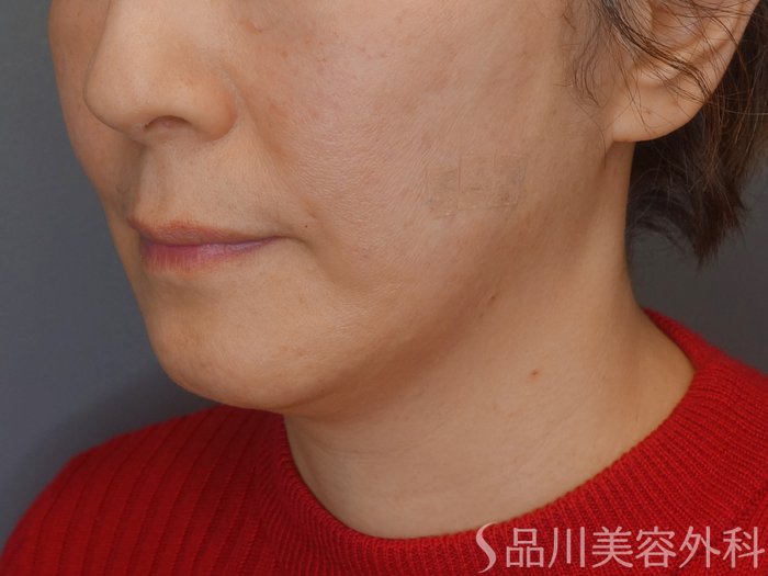 症例NO.72338のAFTER写真