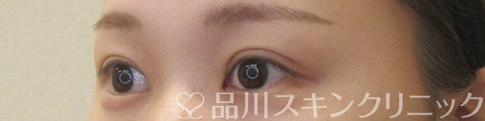 症例NO.73938のAFTER写真
