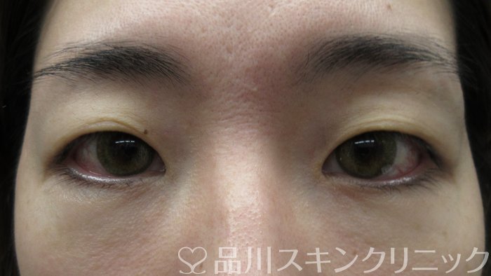 症例NO.71768のBEFORE写真