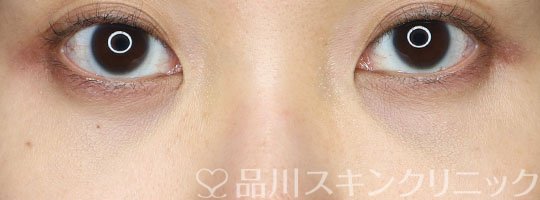 症例NO.63661のAFTER写真