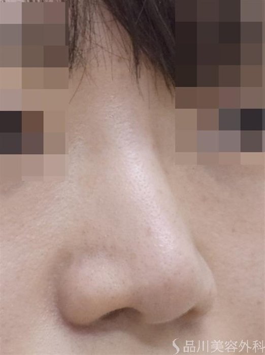 症例NO.47698のAFTER写真