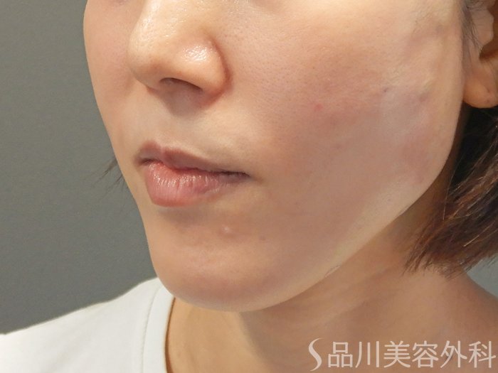 症例NO.71554のAFTER写真