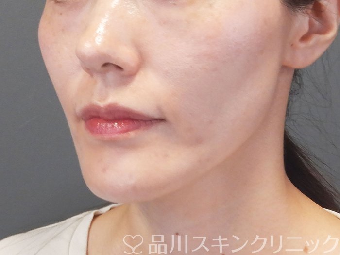 症例NO.75242のAFTER写真