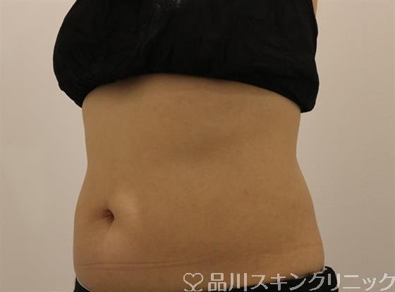 症例NO.43616のAFTER写真