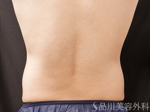 症例NO.73749のAFTER写真