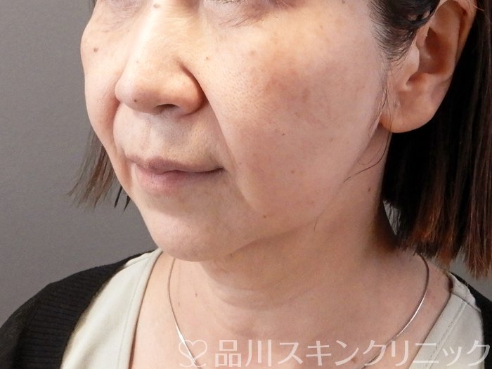 症例NO.66252のBEFORE写真