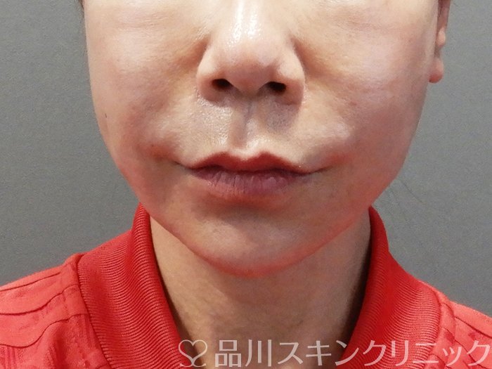 症例NO.72812のBEFORE写真