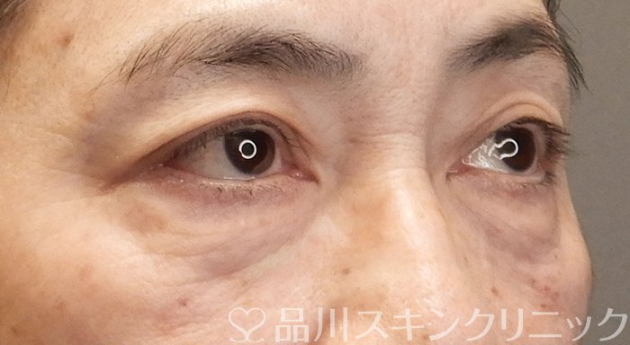 症例NO.70629のAFTER写真