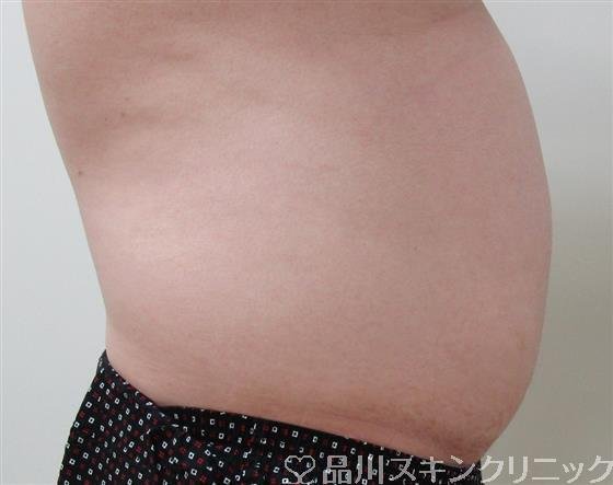 症例NO.32799のBEFORE写真