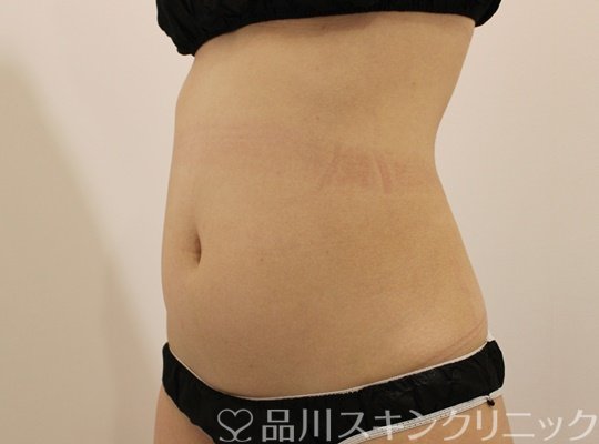 症例NO.75384のBEFORE写真