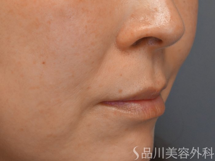 症例NO.69369のBEFORE写真