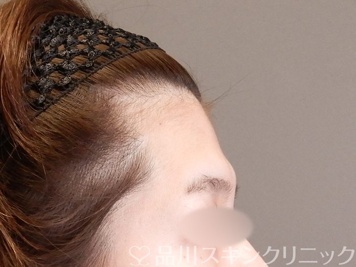 症例NO.63956のBEFORE写真