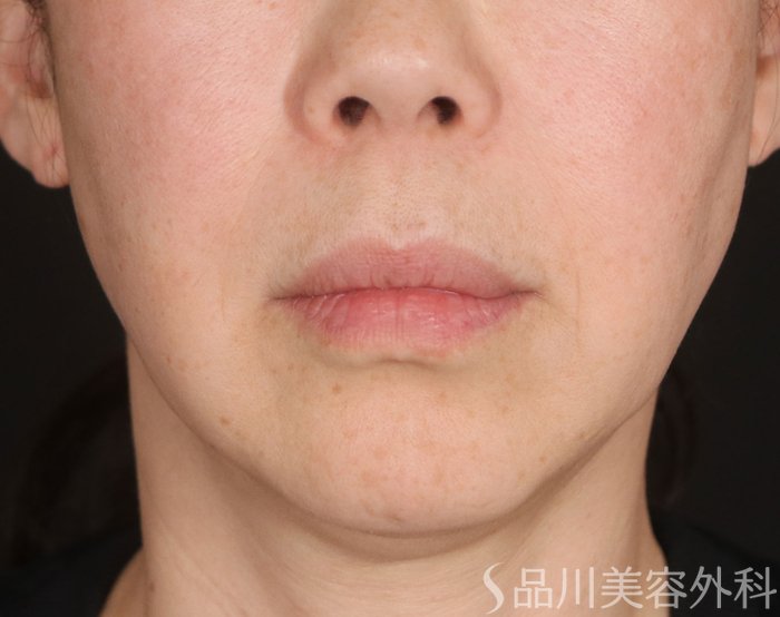 症例NO.73716のBEFORE写真