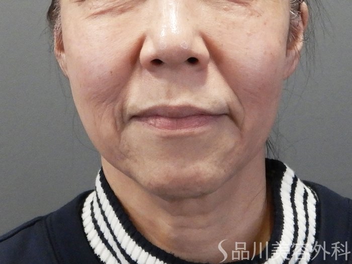 症例NO.74247のBEFORE写真