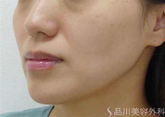 症例NO.31806のBEFORE写真