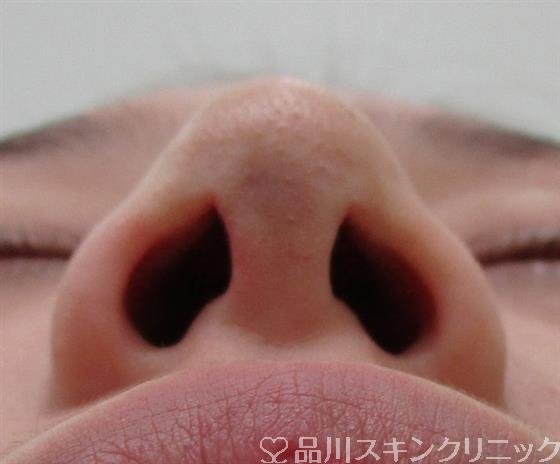 症例NO.31981のBEFORE写真