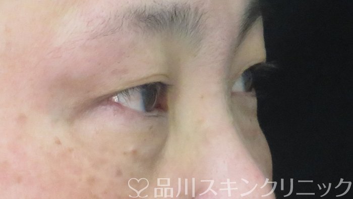 症例NO.72050のBEFORE写真